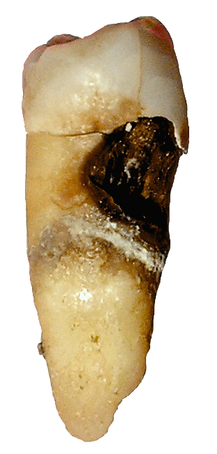 Image of tooth decay - by Dozenist (original) — Lycaon (this one) - from Wikimedia Commons